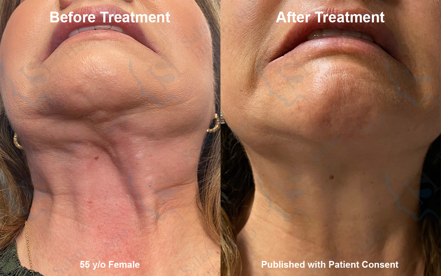 A woman 's neck is shown before and after treatment.
