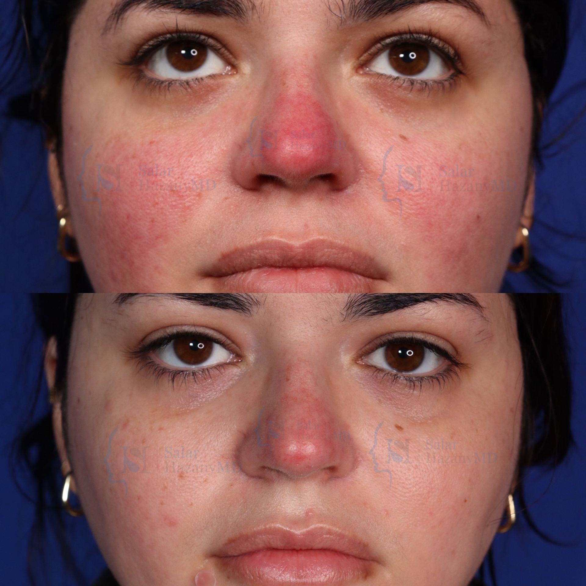 A before and after photo of a woman 's face with rosacea treatment.