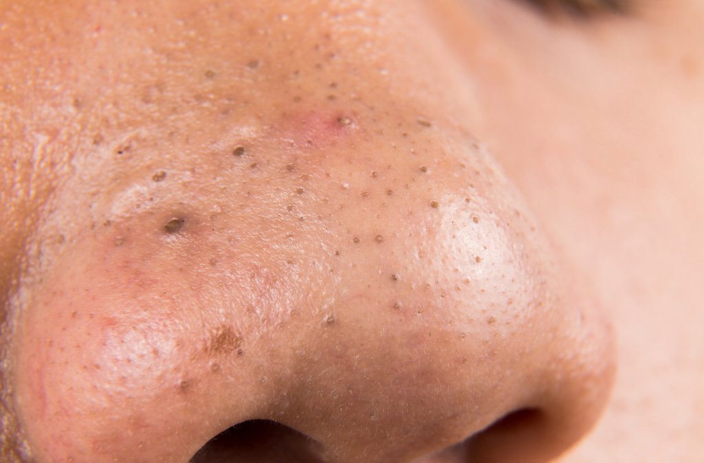 A close up of a person 's nose with black spots on it.