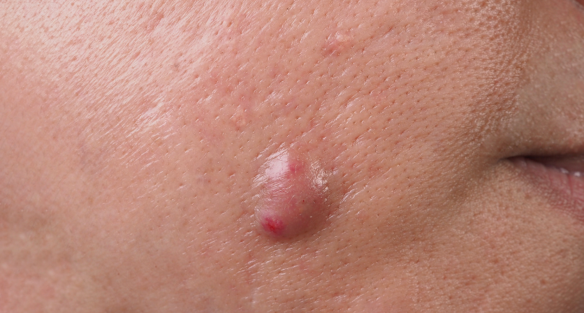 A close up of a person 's face with a pimple on it.