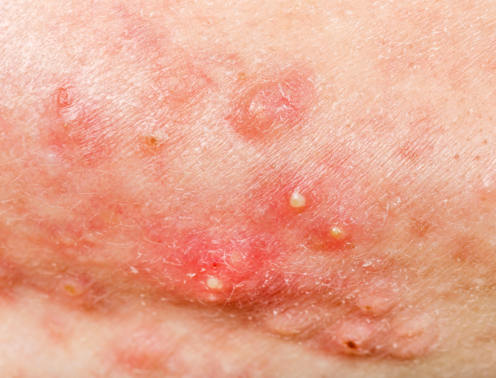 A close up of a person 's face with acne on it.