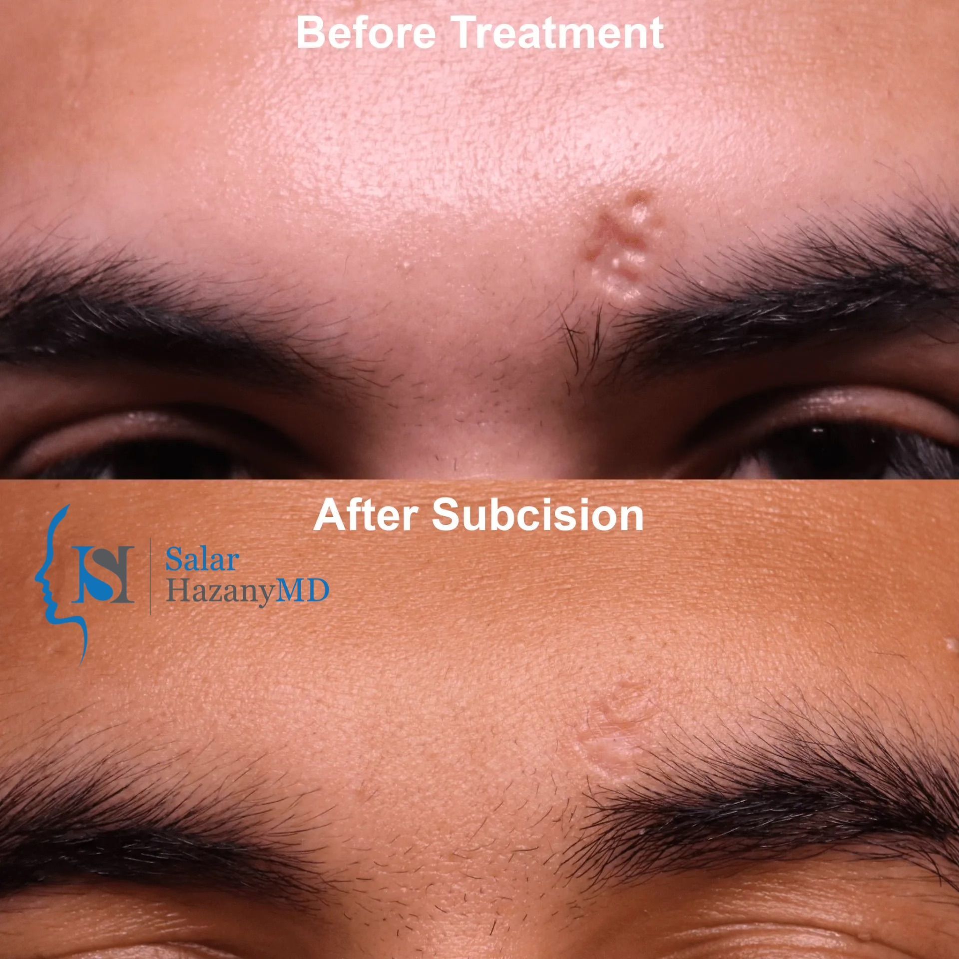 A before and after photo of a man 's forehead with a scar.