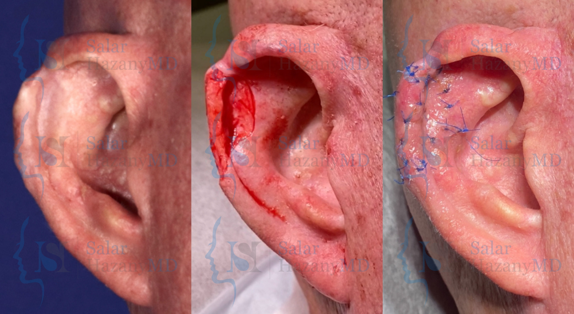 A man with a beard and scars on his face before and after surgical revision.