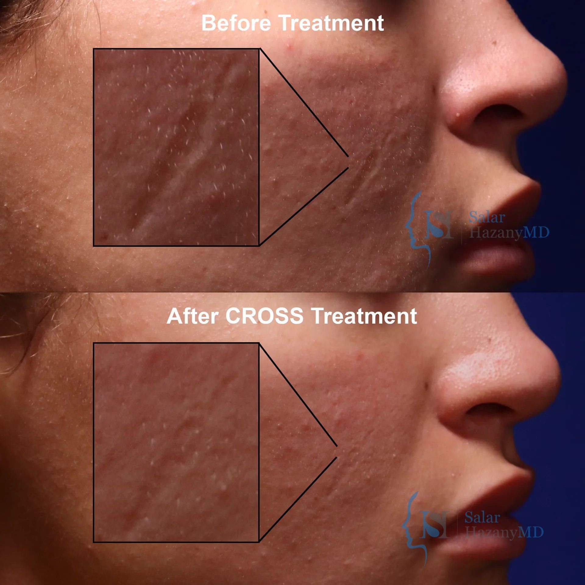 A before and after photo of a woman 's face with a cross treatment.