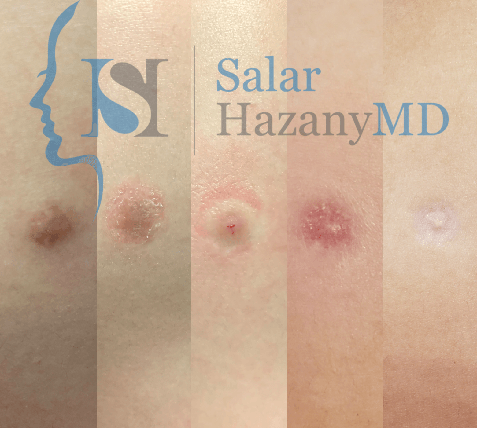 A close up of a person 's skin with the name salar hazany md on the bottom