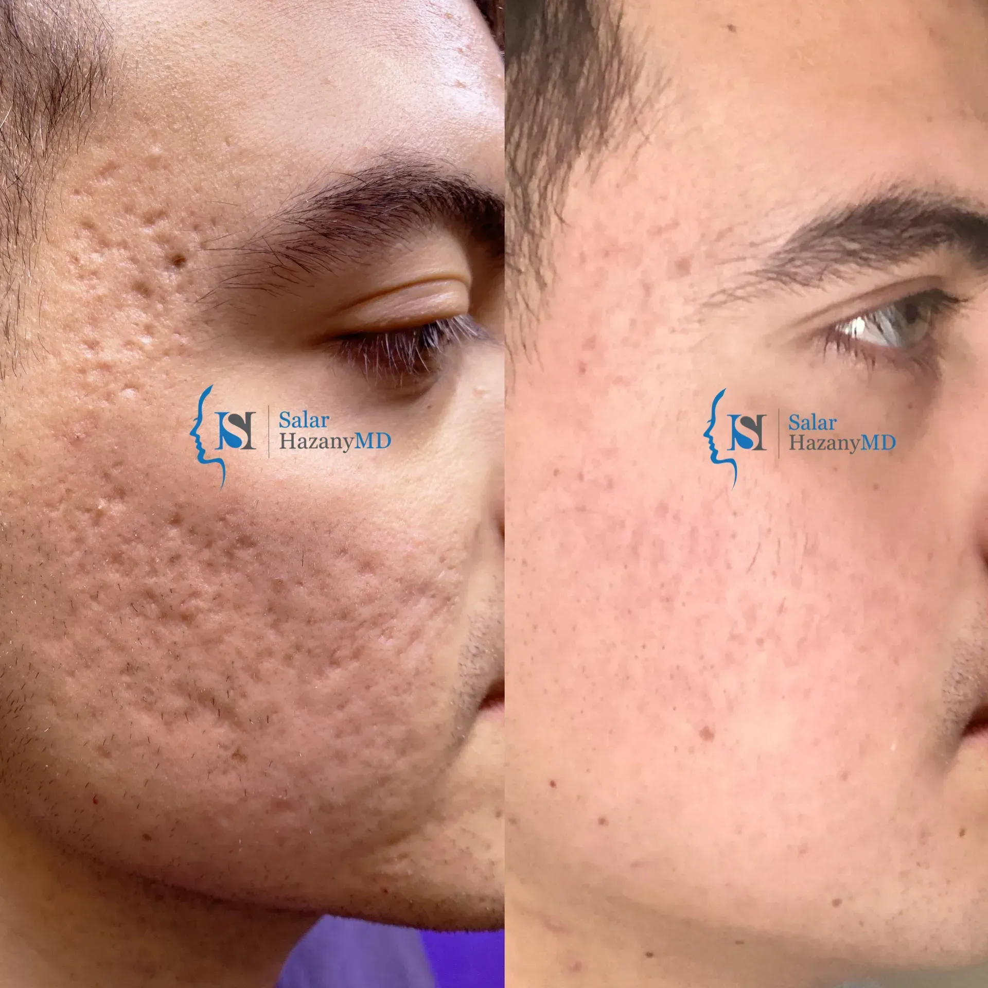 A man 's face is shown before and after two treatments.
