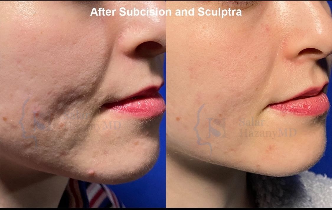 A woman 's face is shown before and after treatment.