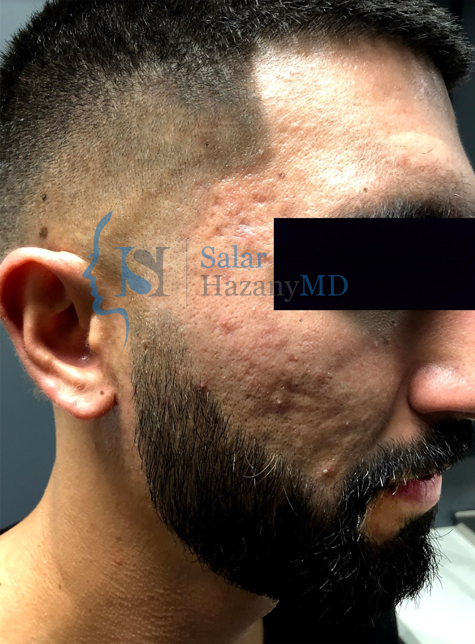 Before Image of a Bearded Person's face with Acne Scars