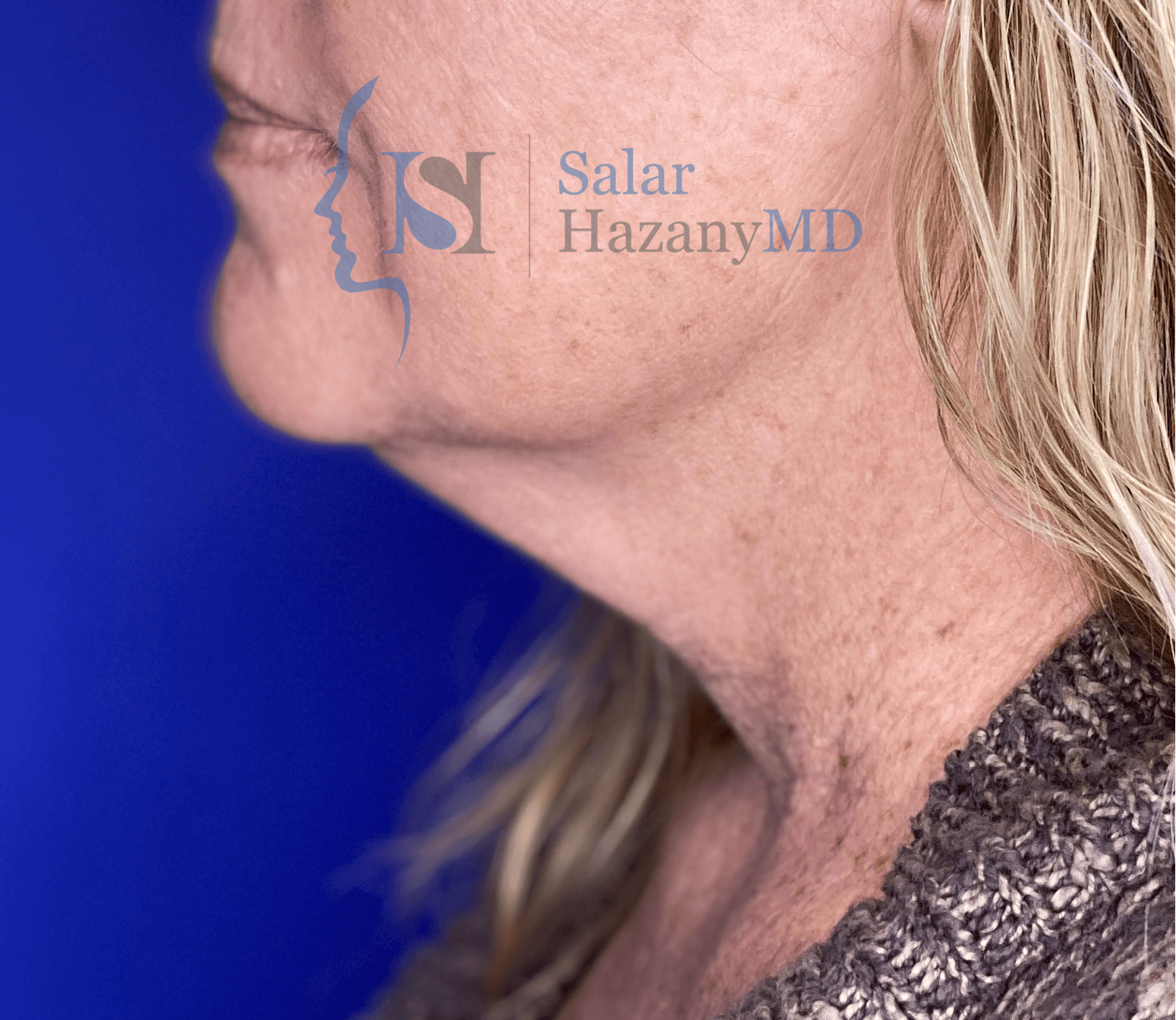 Image before neck lift surgery - woman with loose skin around neck area