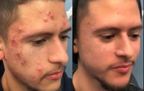 Image of Cystic Acne and Inflammatory Acne