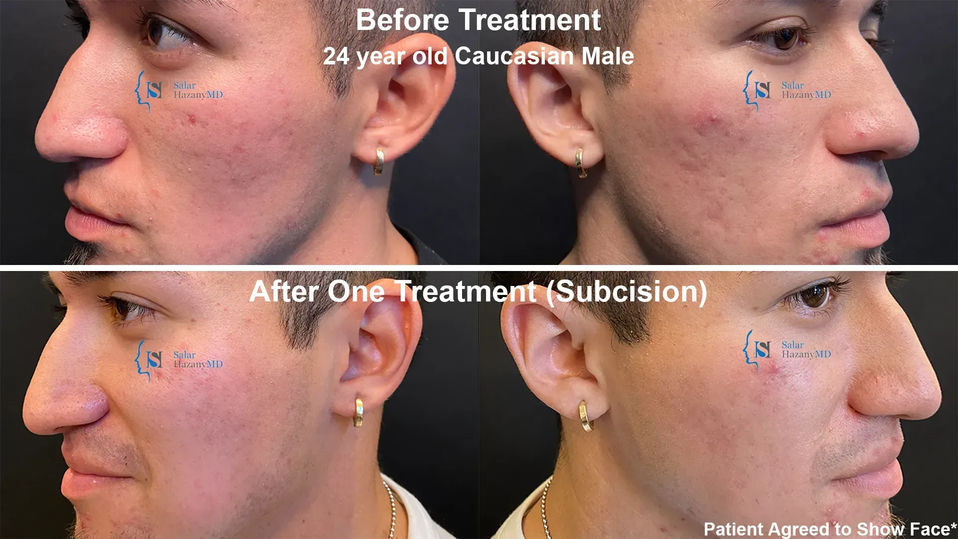 A before and after photo of a man 's face.