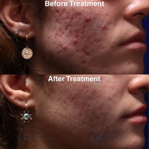 A before and after photo of a woman 's face with acne.