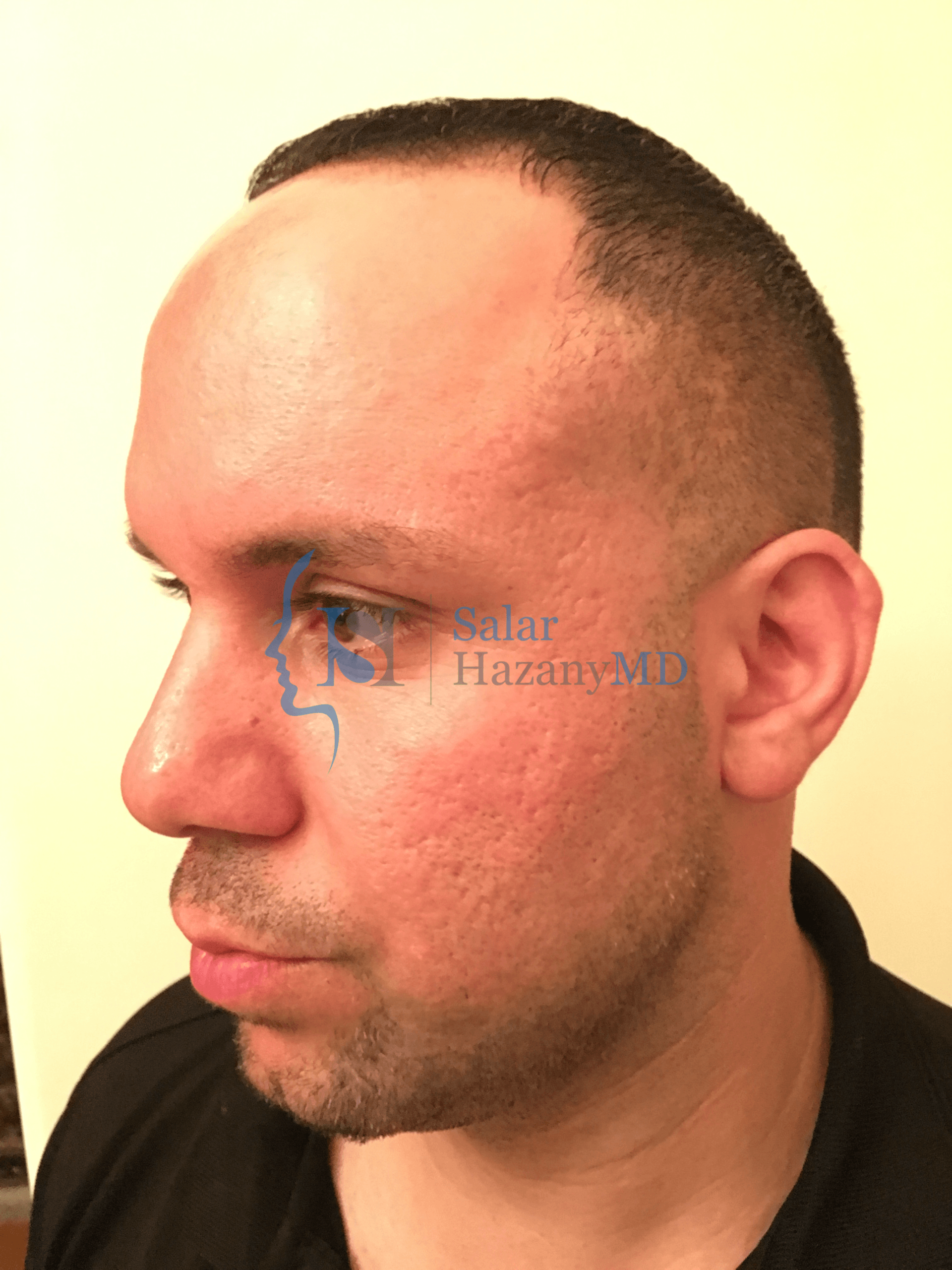Person's side profile face after acne scar treatment
