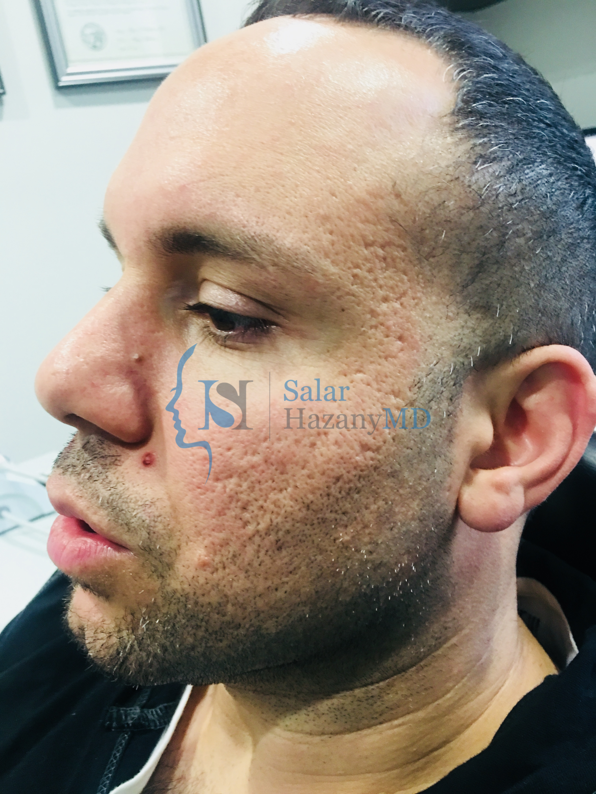 Person's side profile face with acne scars before treatment