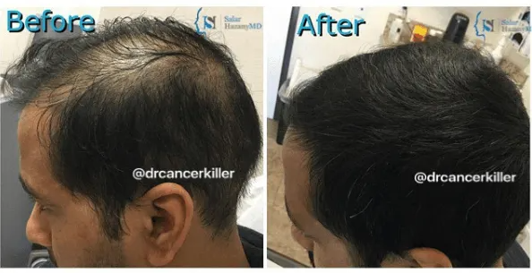 A before and after photo of a man 's hair growth.