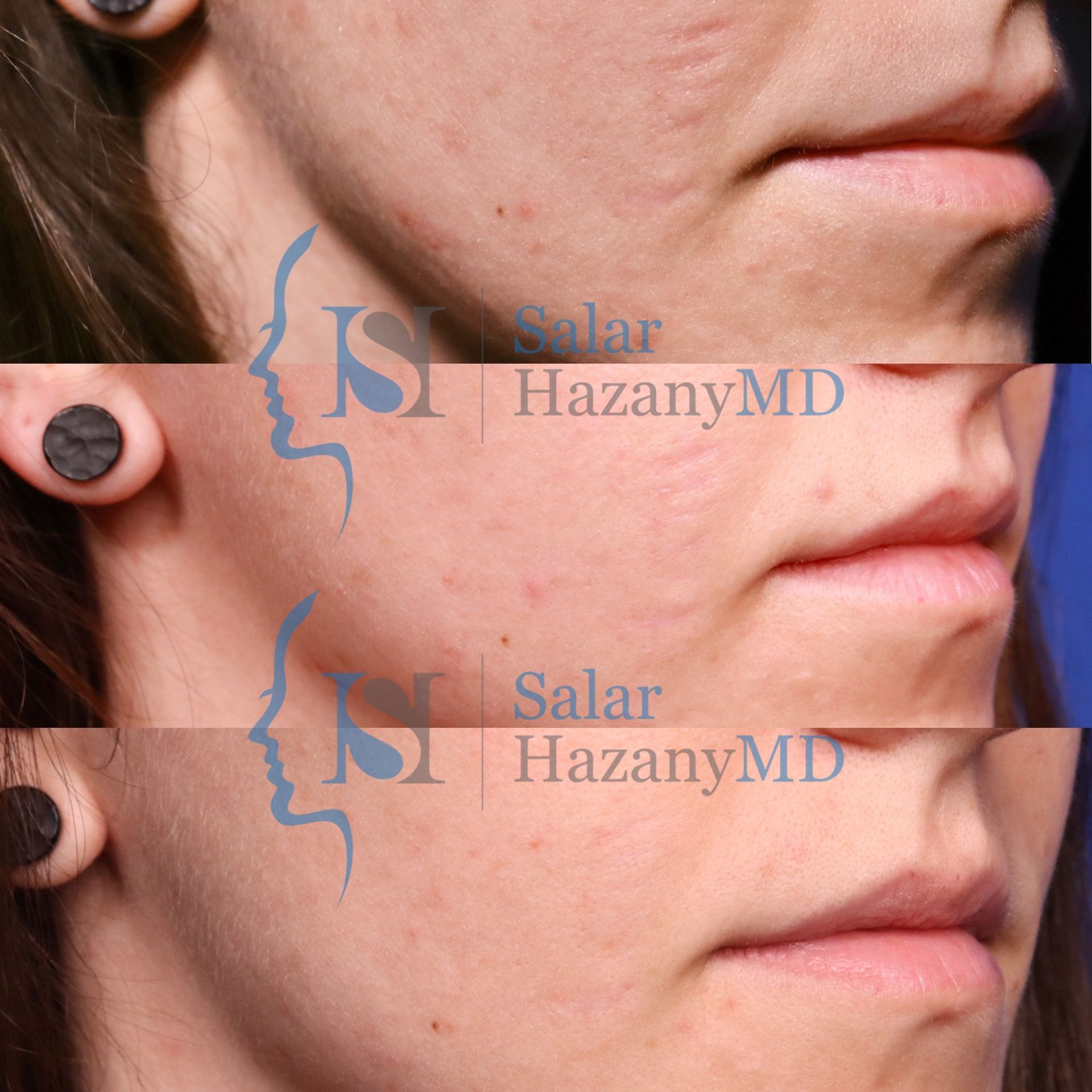 A before and after photo of a woman 's face by salar hazany md