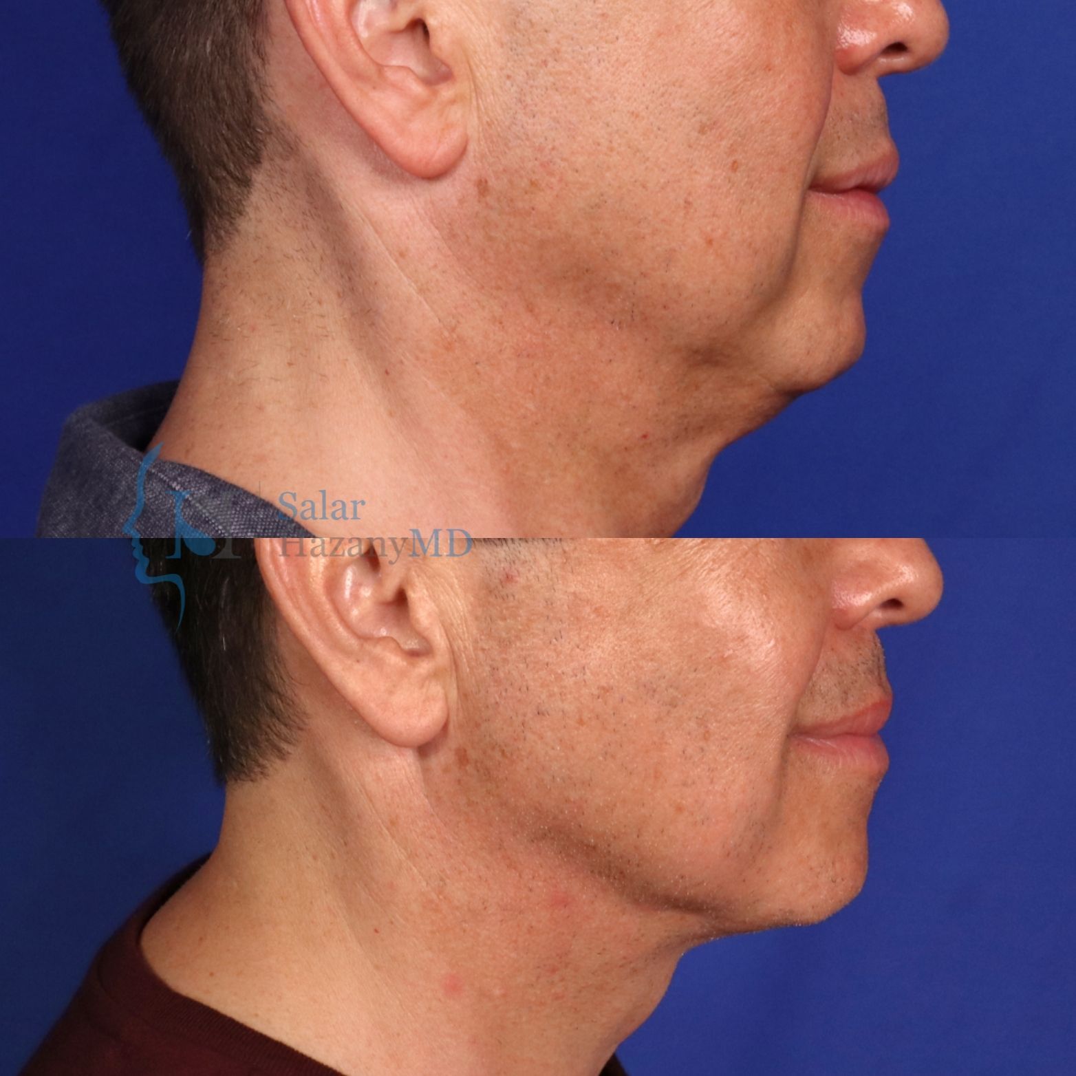 A before and after picture of a man 's neck