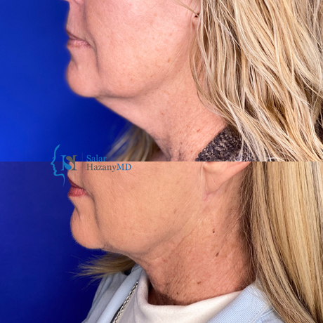 A before and after photo of a woman 's neck and face
