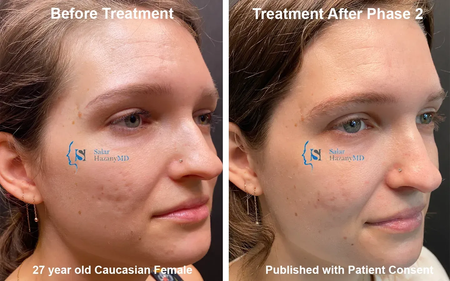 A woman 's face is shown before and after treatment.