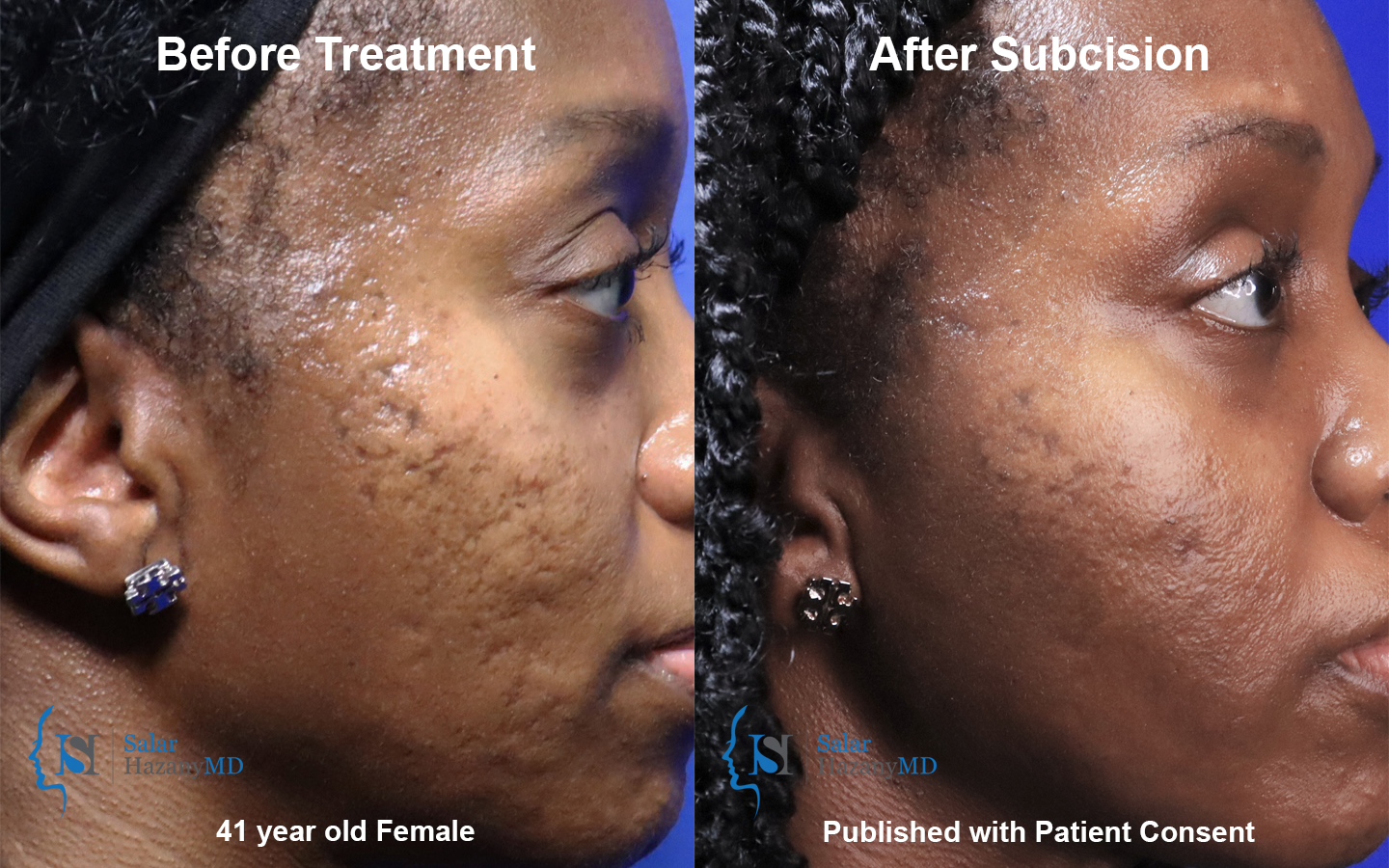A woman 's face is shown before and after treatment.