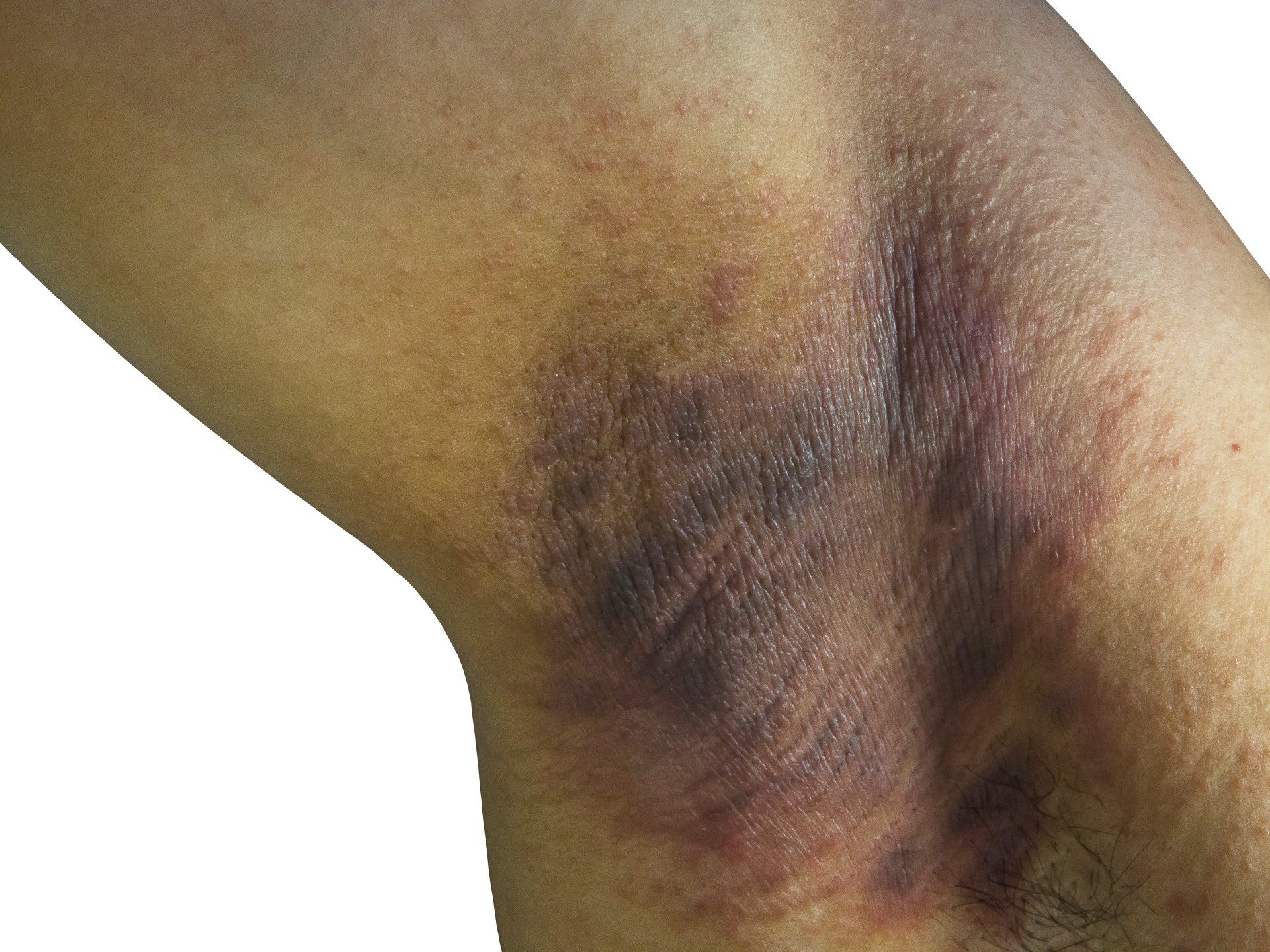 Image of Hidradenitis Suppurativa in Armpit of African American Woman
