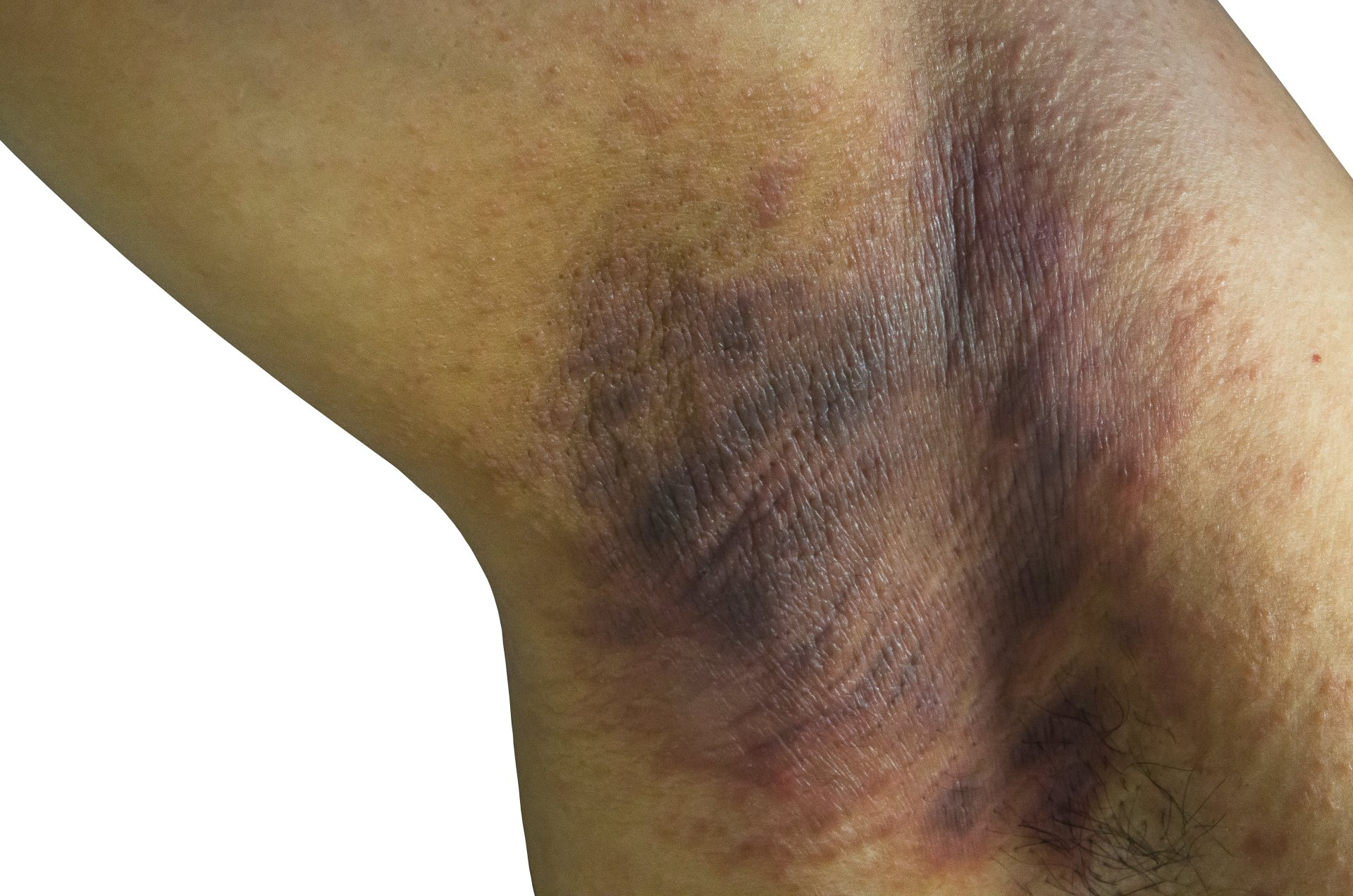 Hidradenitis suppurativa in a woman's under arm area