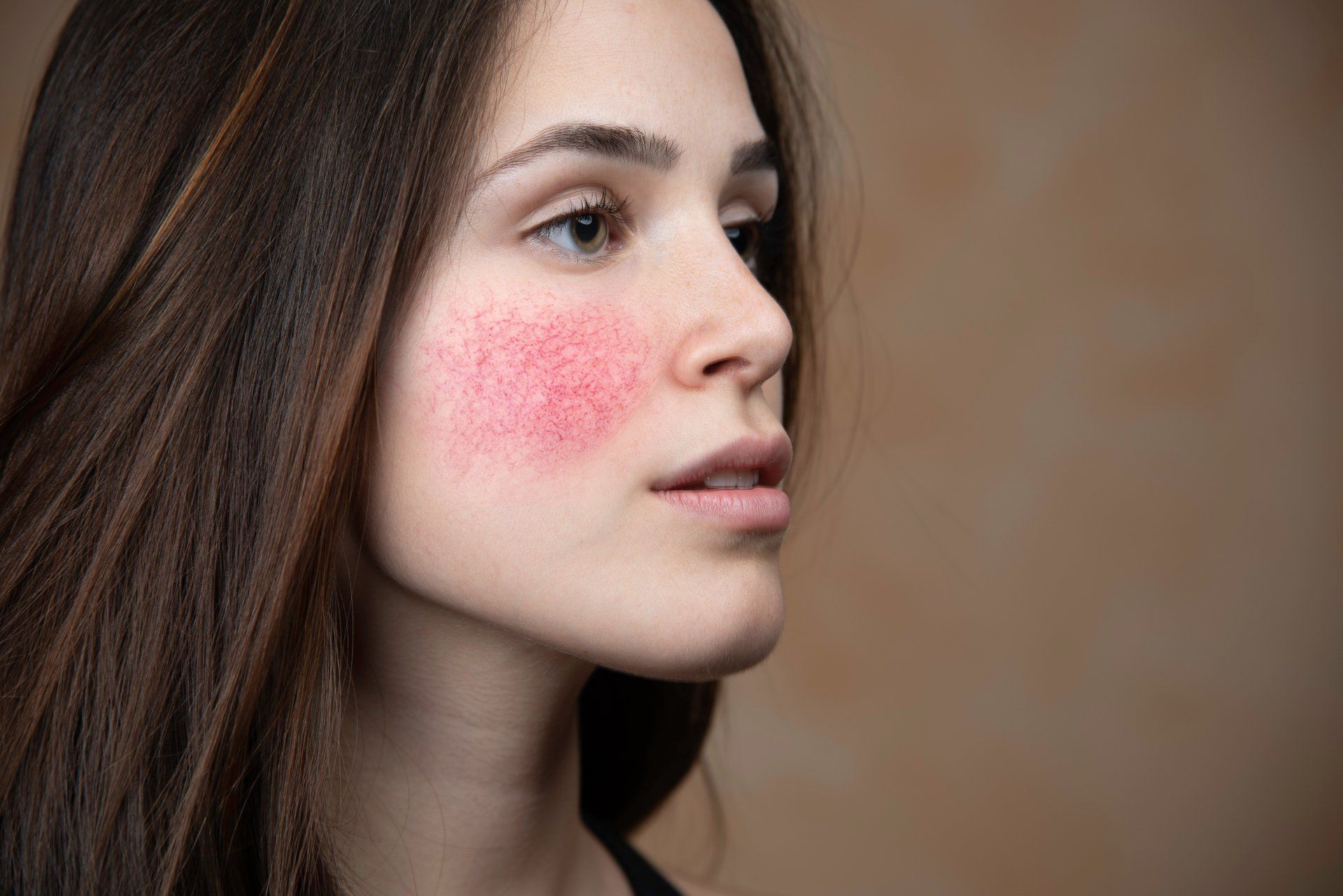 Rosacea and Skin Redness on the Right Cheek of a Caucasian Woman