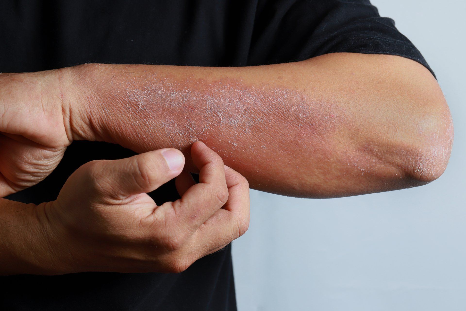 Man scratching eczema on his left arm