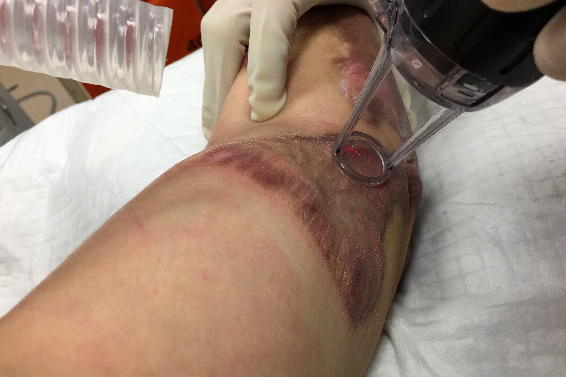Image of Laser Treatment of Contracture Scar on Man's Arm