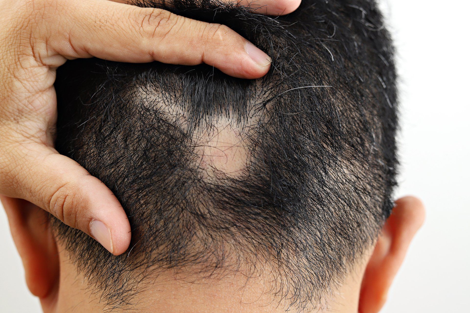 Back of the head of a man with alopecia areata (a type of hair loss)