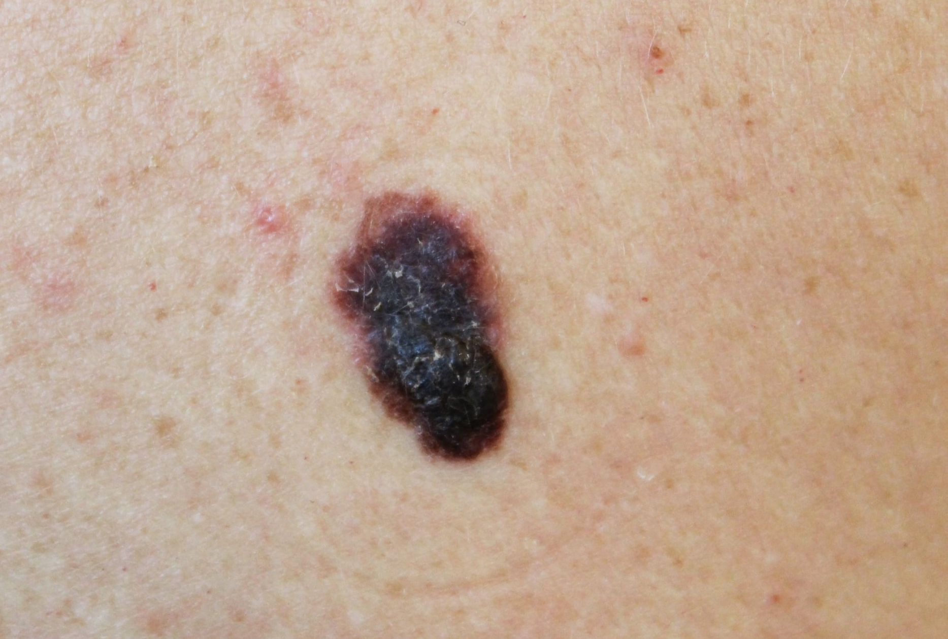 Melanoma on Caucasian Skin Zoomed-In
