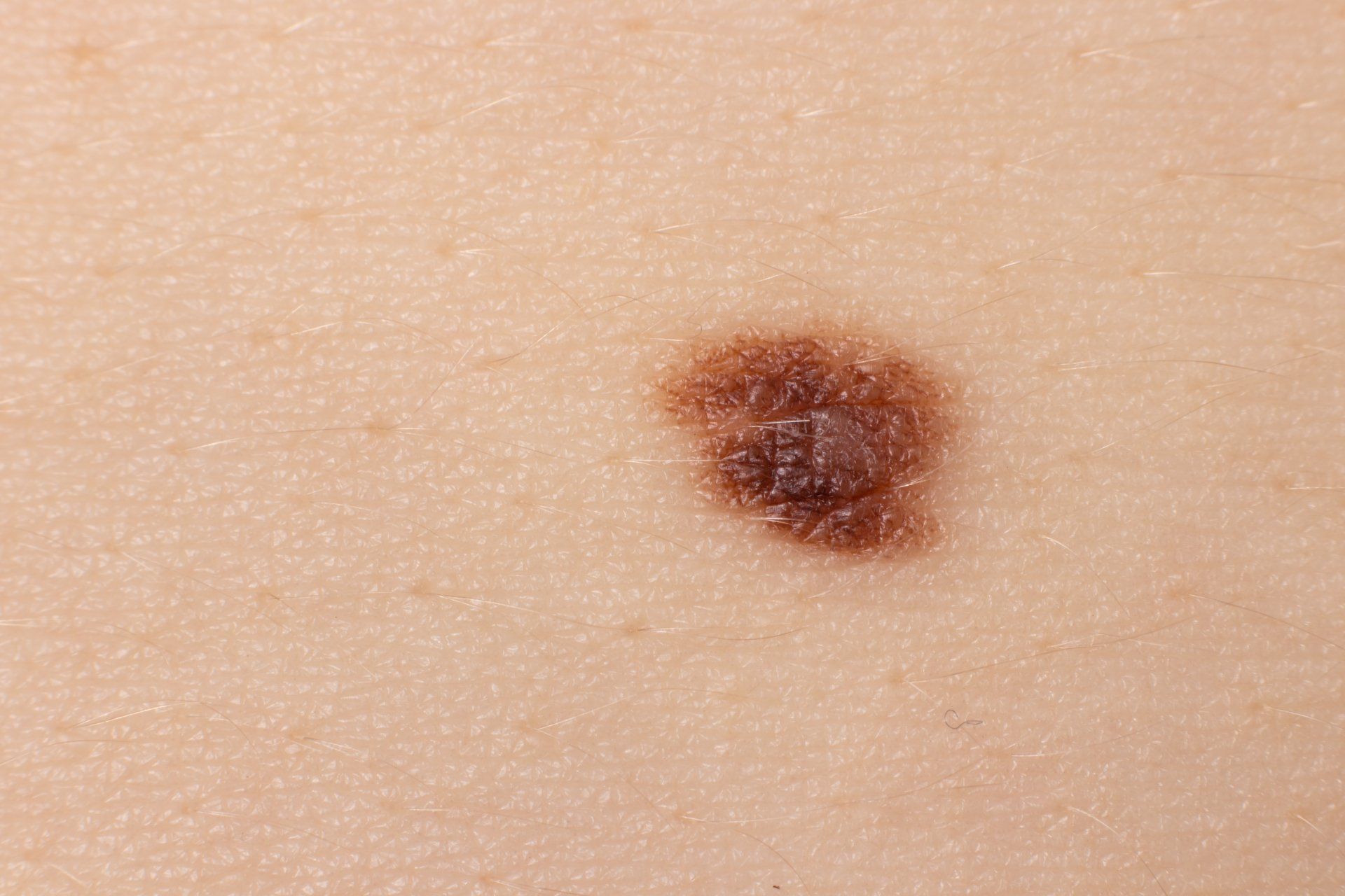 Image of a Mole, Zoomed-In on Caucasian Skin