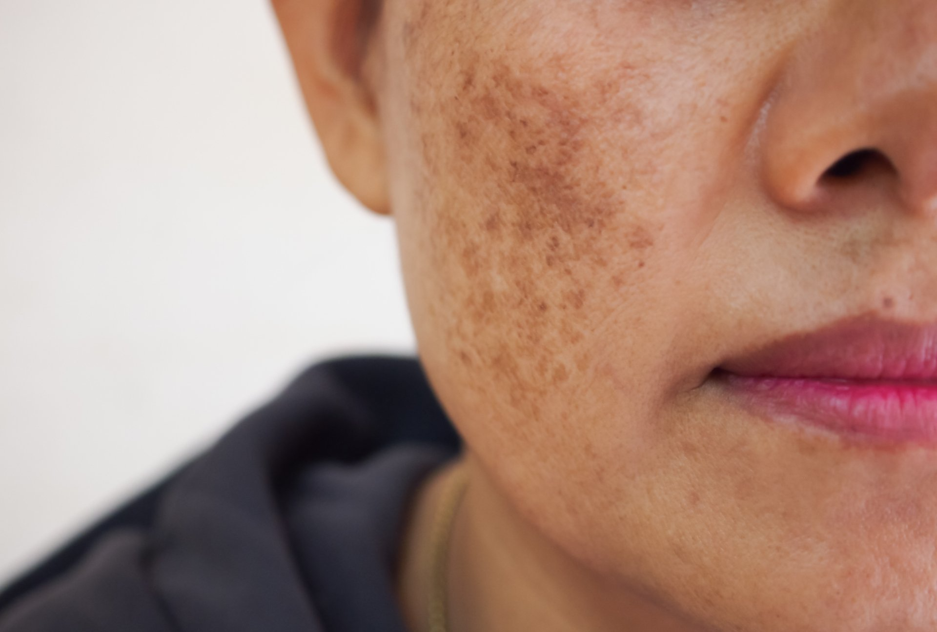 Image of Melasma on Woman's Face