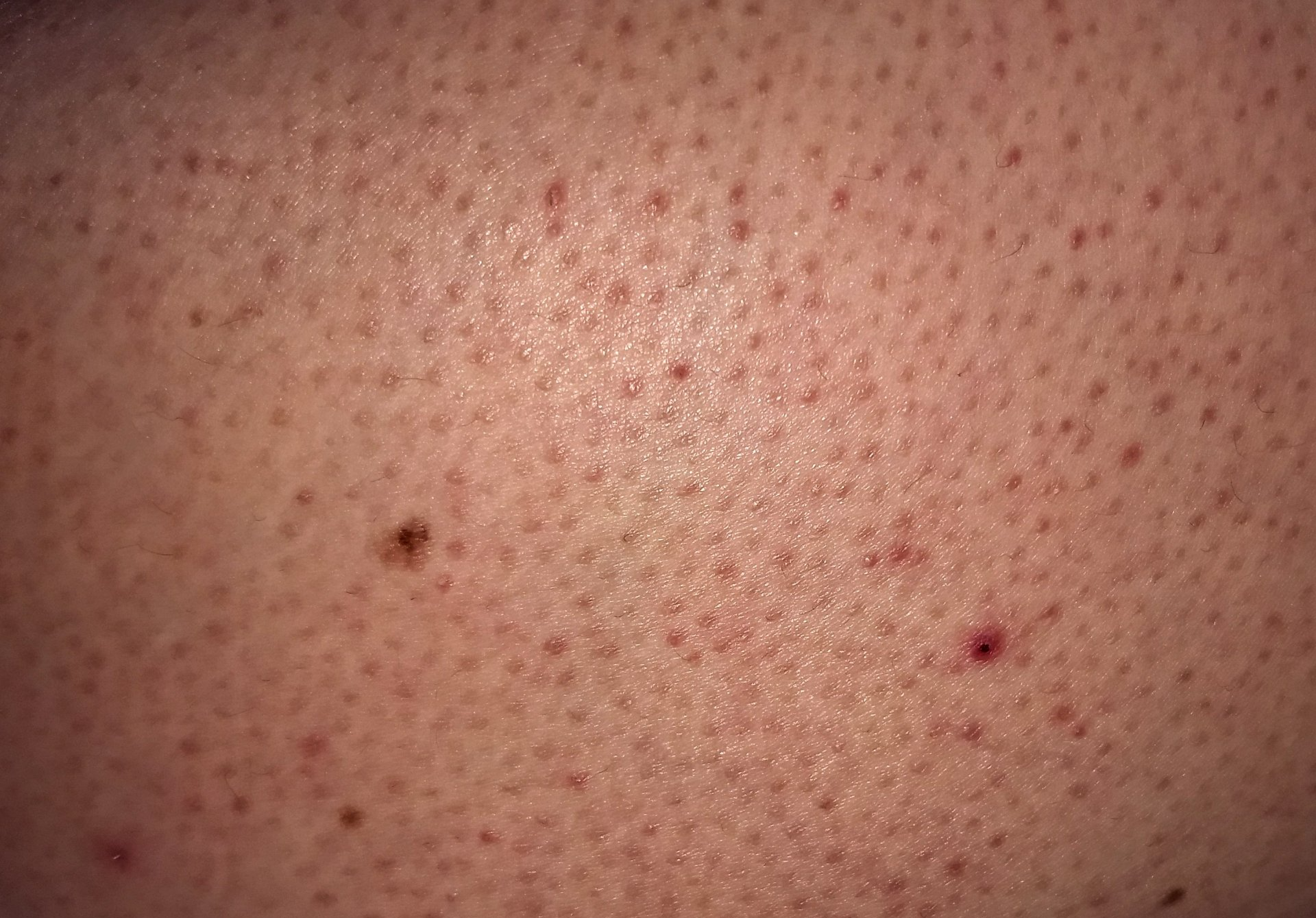Zoomed in image of Caucasian Skin with Keratosis Pilaris