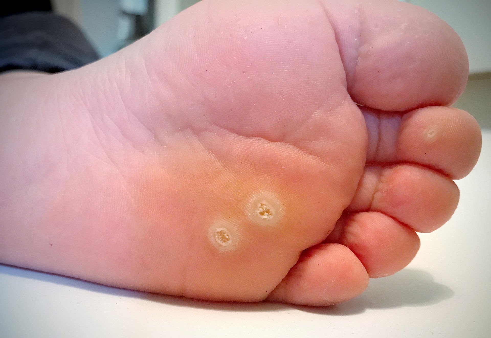 Bottom a man's left foot with plantar warts (warts on the bottom of the foot)
