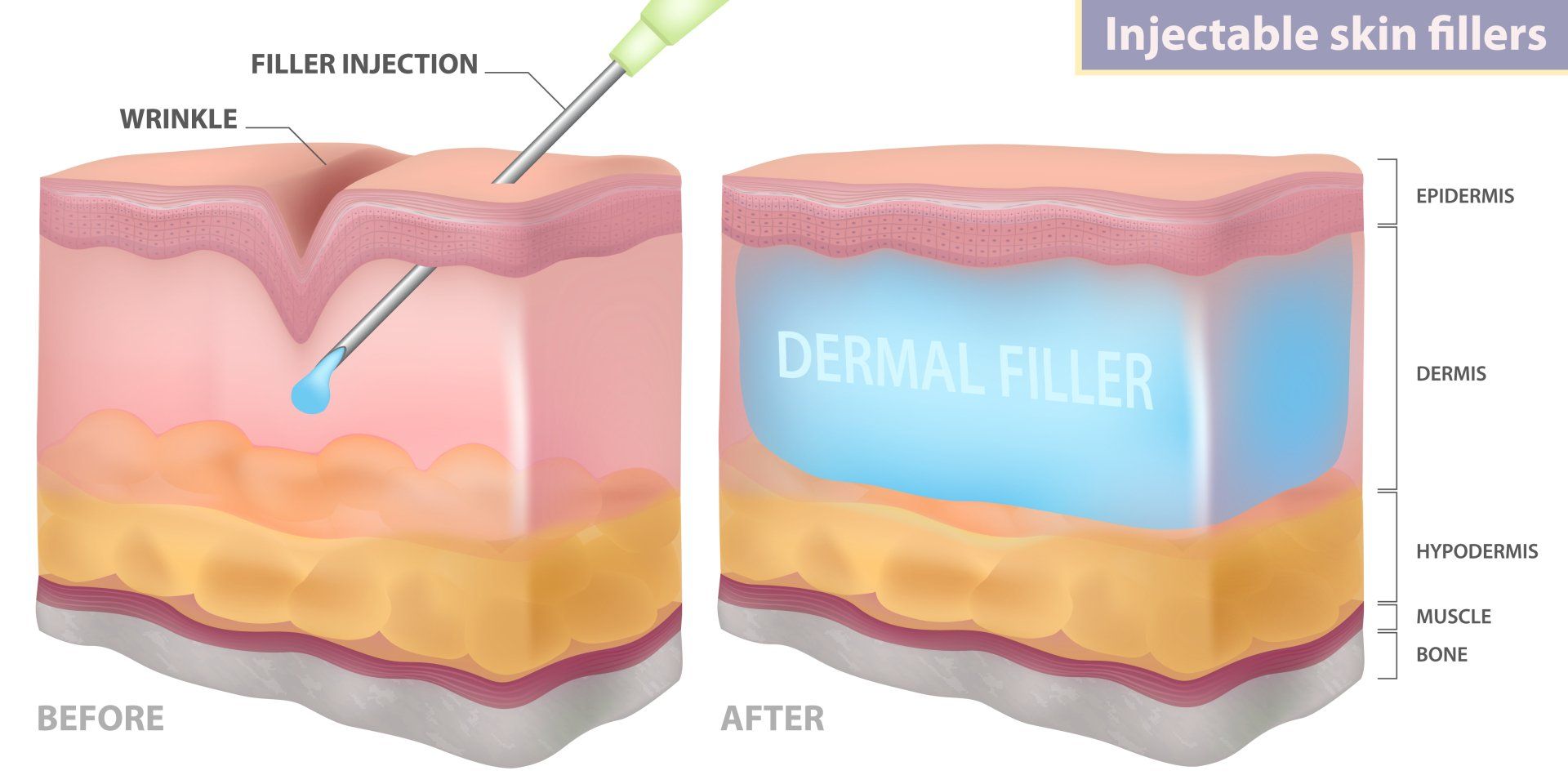 Dermal Fillers Enter into The Dermis and Support Creases and Wrinkles That are on the Upper Layers of Skin