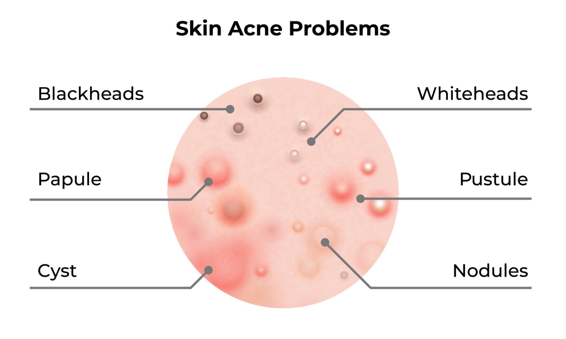 Graphic/Drawing of Types of Active Acne: Blackheads, Whiteheads, Papules, Pustules, Cysts, and Nodules