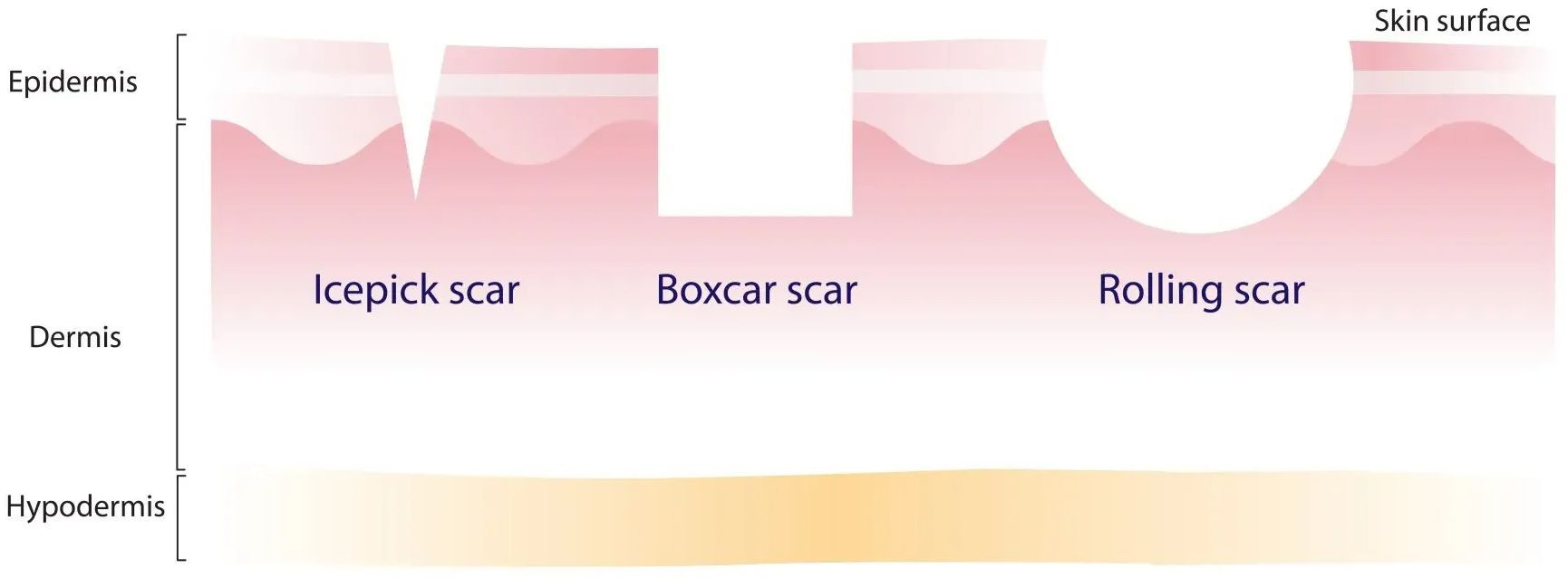 Image of All Different Acne Scars: Boxcar, Icepick, and Rolling Scars