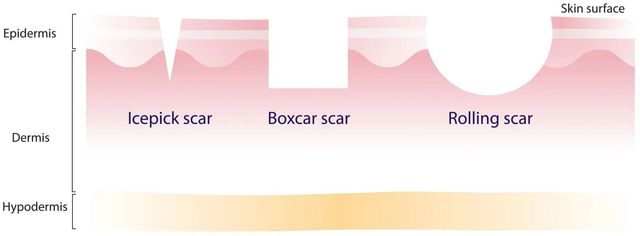 Boxcar acne scars sales