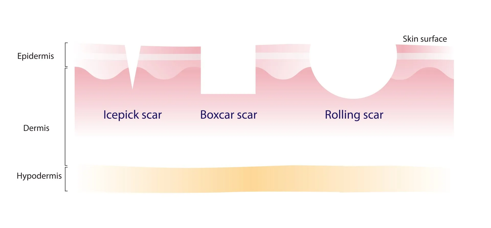 Image of All Different Acne Scars: Boxcar, Icepick, and Rolling Scars
