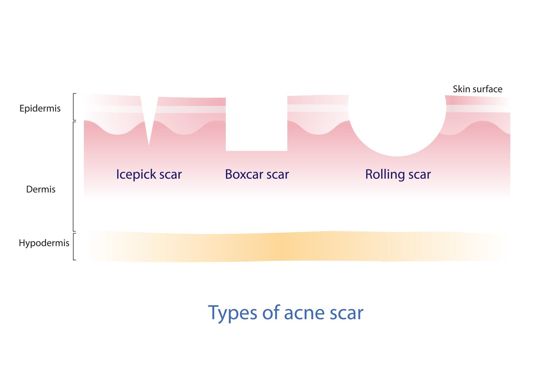 Types of Active Acne. Los Angeles Acne Scar Treatment