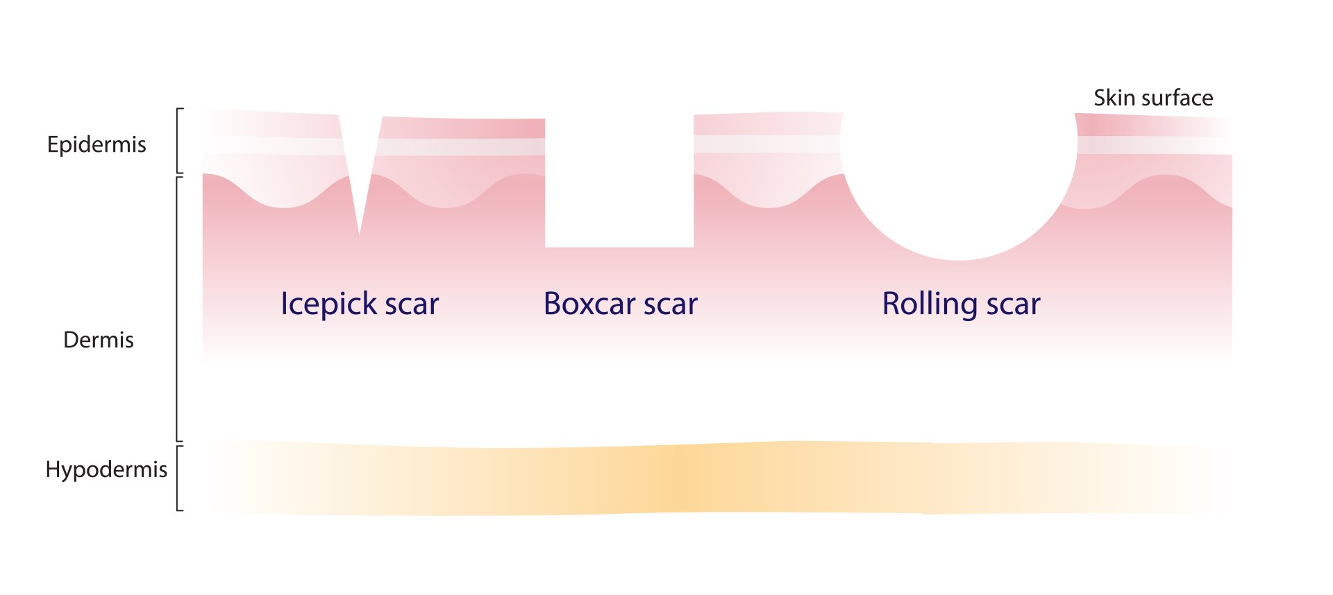 Types of Acne Scars Image