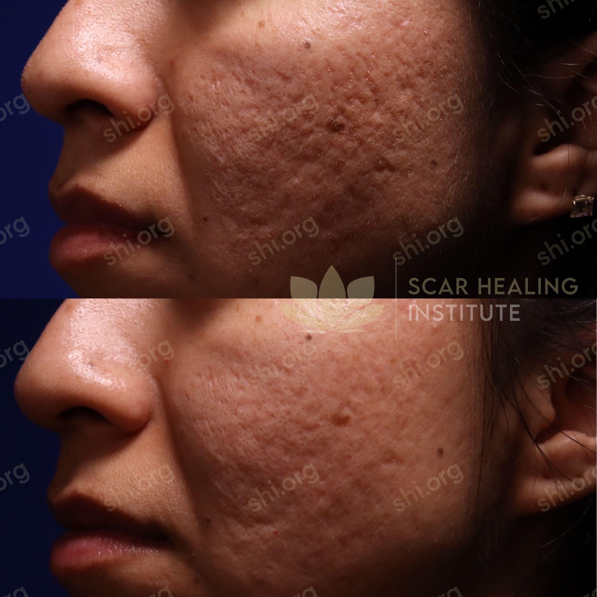 A before and after photo of a woman 's face from the scar healing institute