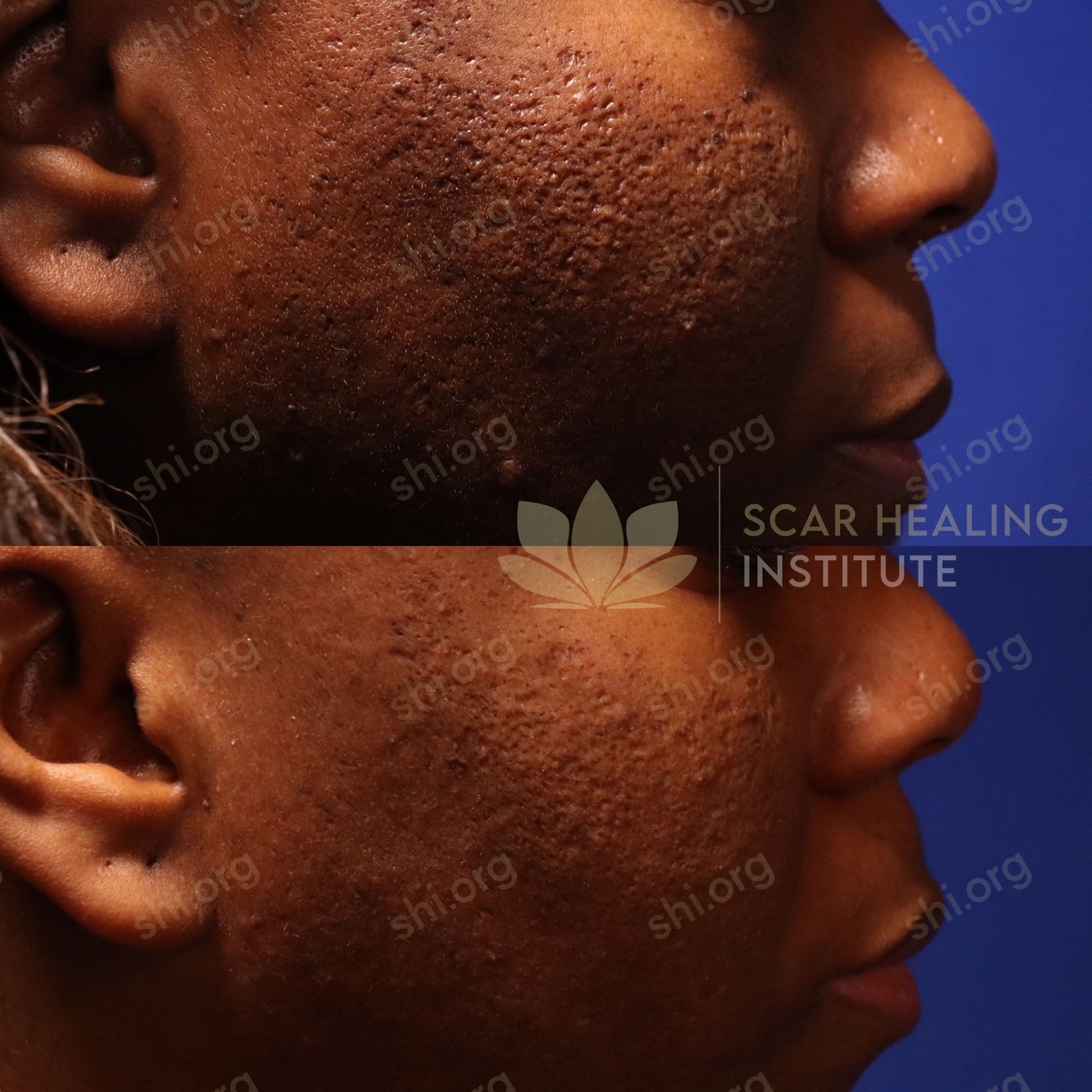 A before and after photo of a man 's face at the scar healing institute