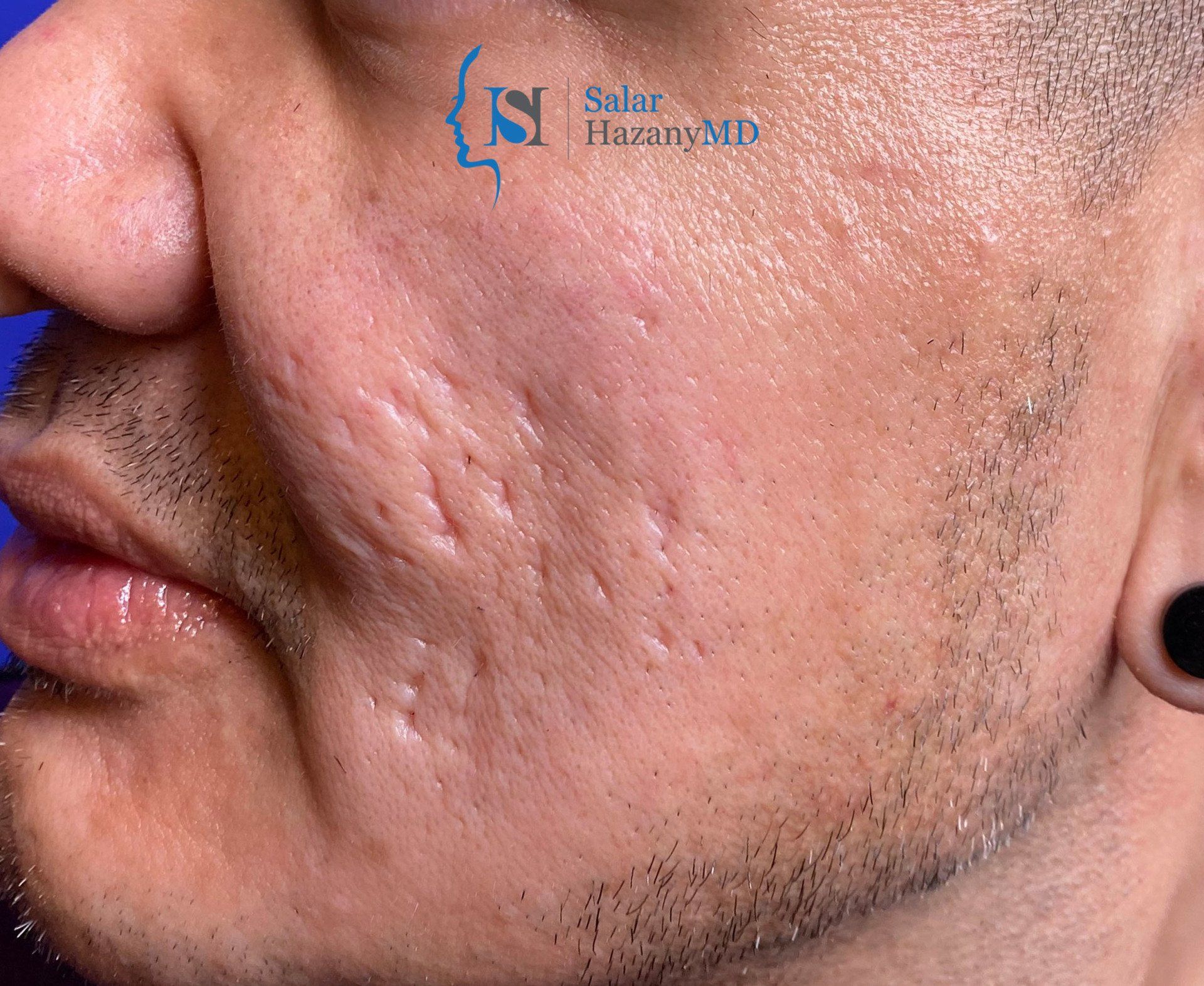 Looking for the World's Best Acne + Acne Scar Doctor?