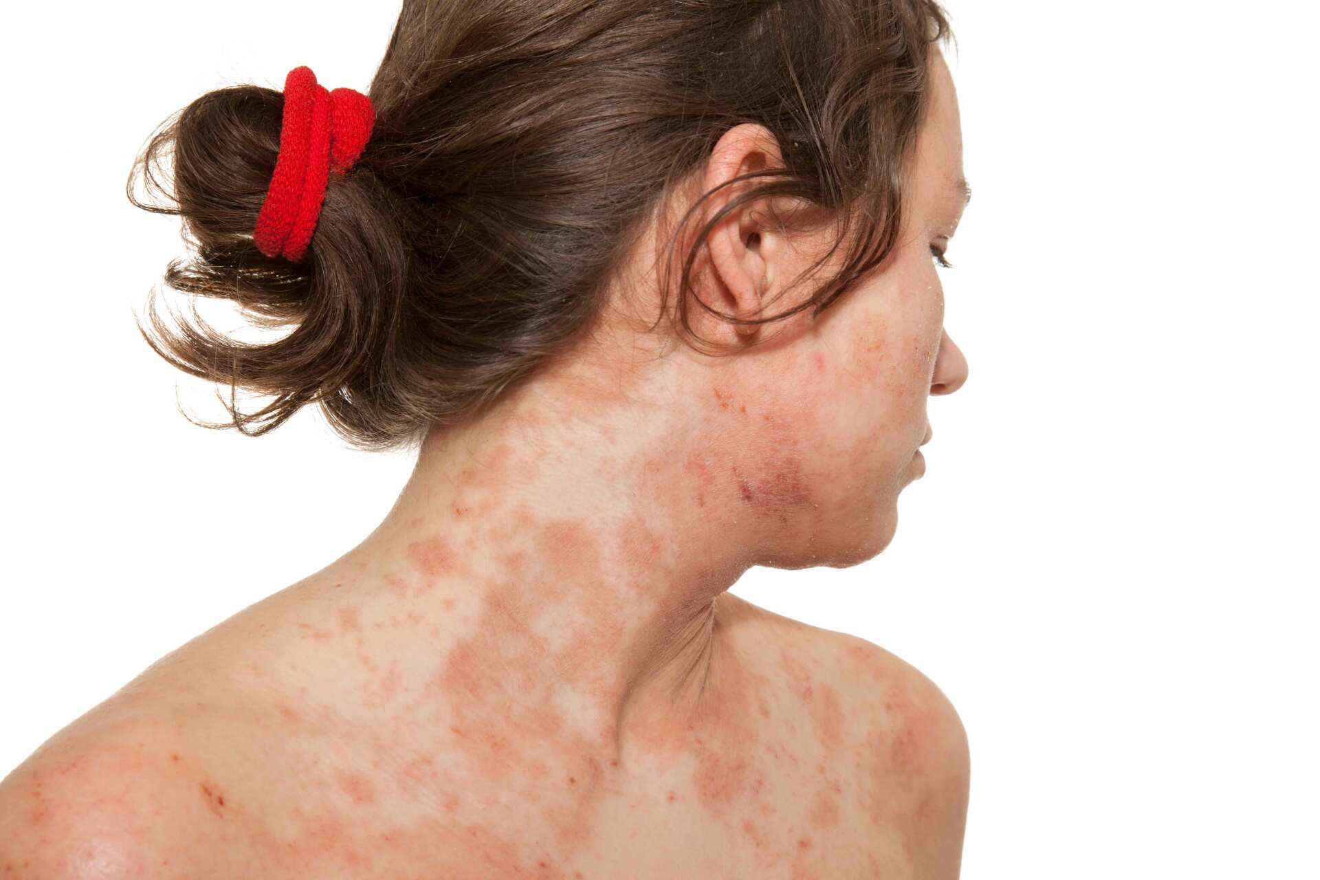 Woman With Skin Allergy — Lexington, KY — Allergy Asthma & Immunology: Dr. Iraklis Livas