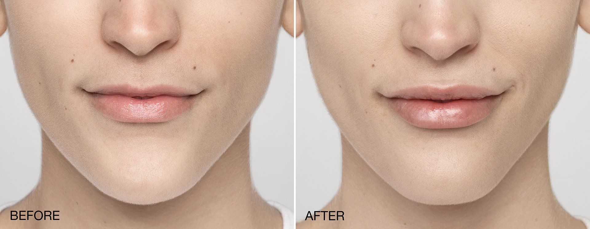 Restylane before and after photos