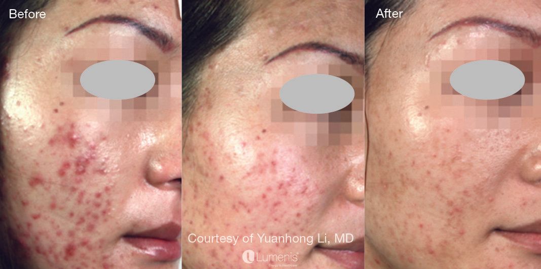 before and after IPL laser treatment