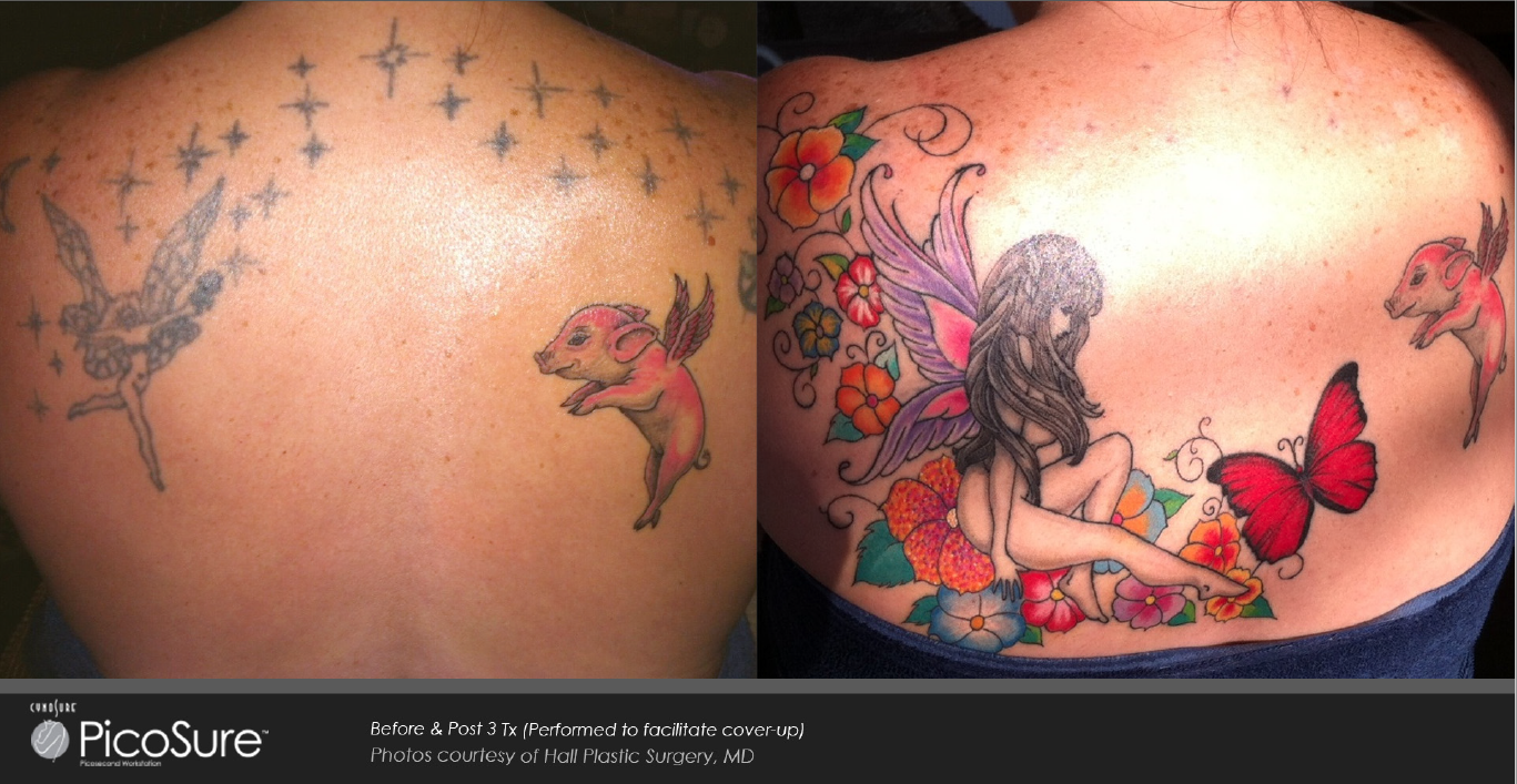 Before and after photos of laser tattoo removal