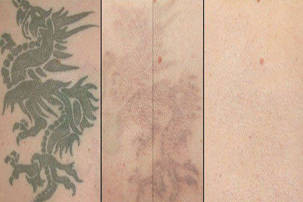 What to expect from your first tattoo removal